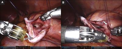 A combined approach of robot-assisted laparoscopic pyeloplasty and flexible endoscopy to treat concomitant ureteropelvic junction obstruction and calyceal stones in children: Technical considerations and review of the literature